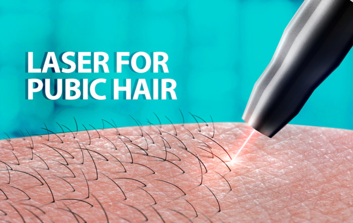 Laser for pubic hair